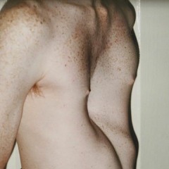 Pectus Excavatum