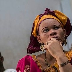 UNESCO yabaini mafanikio katika ulinzi wa Albino