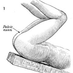 Septumrectovaginale Part 1