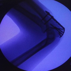 Subcutaneous