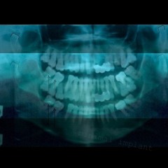 Minimal Implant  (minimal Techno Mix - Fev 2017)