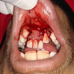 Guilloteens (Prod. Death Grips)