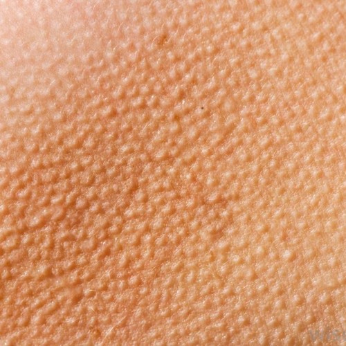 gellaitry's goosebumps