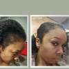 Hair Transplant For Women Before And After - YouTube Video With Dr. Huebner
