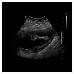 NYM007 - Toboggan - Ultrasounds