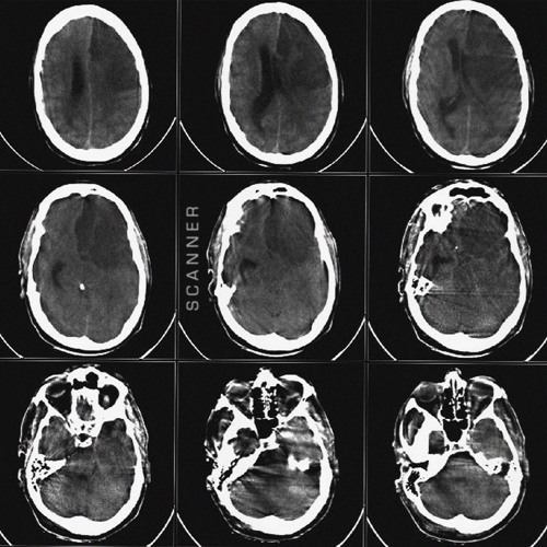 Как выглядит мозг после инсульта Parietal in SCANNER