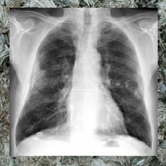ASBESTOSIS