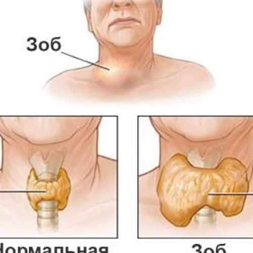 Как выглядит зоб у человека