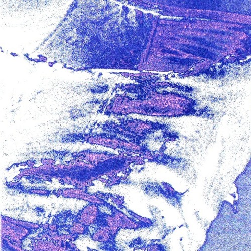 Cemetery - ADD (from excoriation (瘢痕))