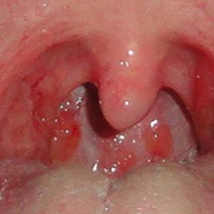 Throat Cancer Stage 3 - Dr. Joel Wallach