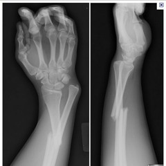 Fracture