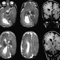 Sickness Brains