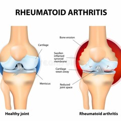 Ayurvedic Treatment Of Rheumatoid Arthritis & Joint Pain