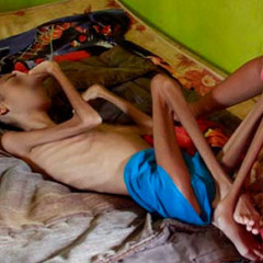 Deficit Nutricional De Niños Venezolanos