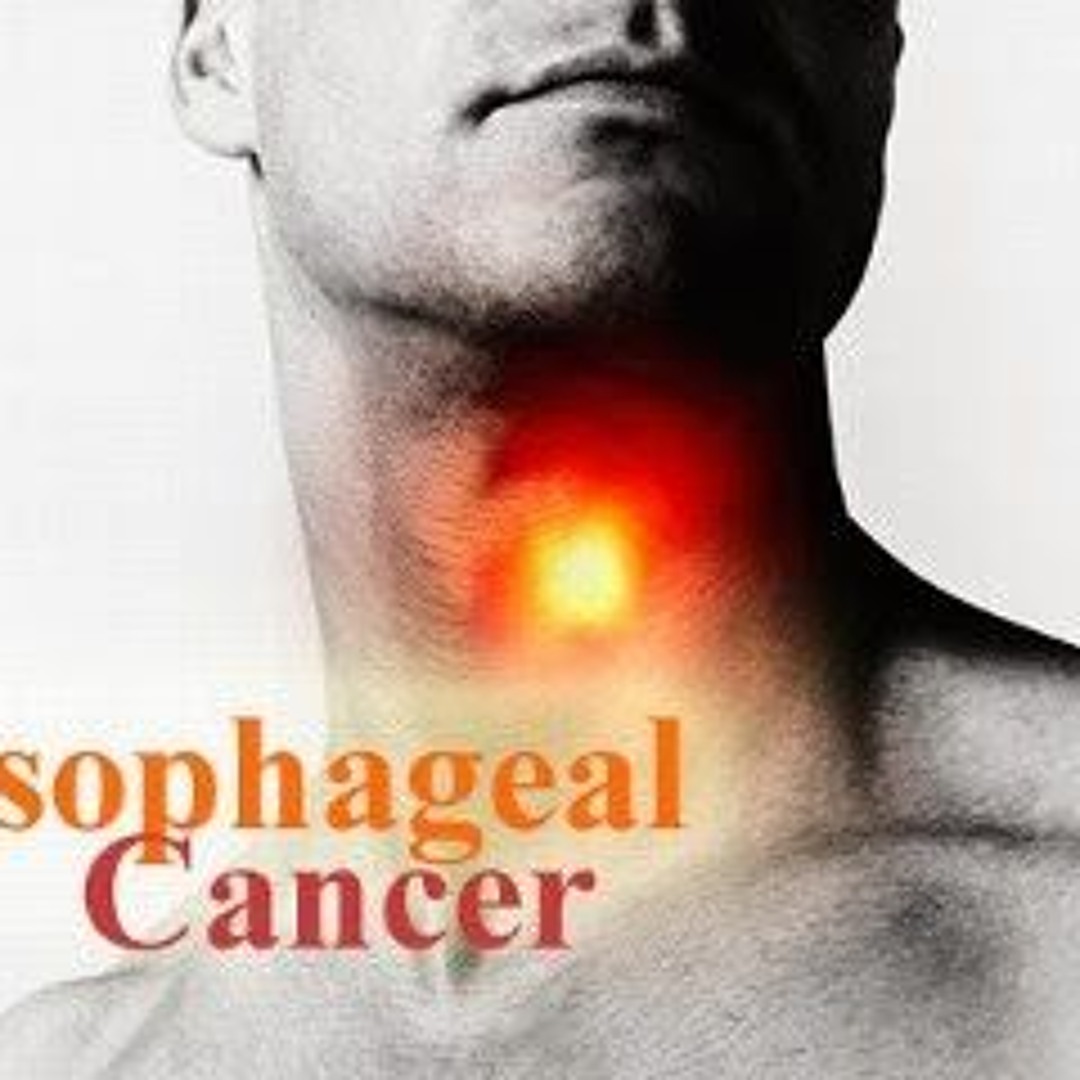 Stream Warning Symptoms And Signs Of Esophageal Cancer By Refluxmd Stream Warning Symptoms And Signs Of Esophageal Cancer By Refluxmd