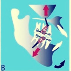 In the language of orthodontics