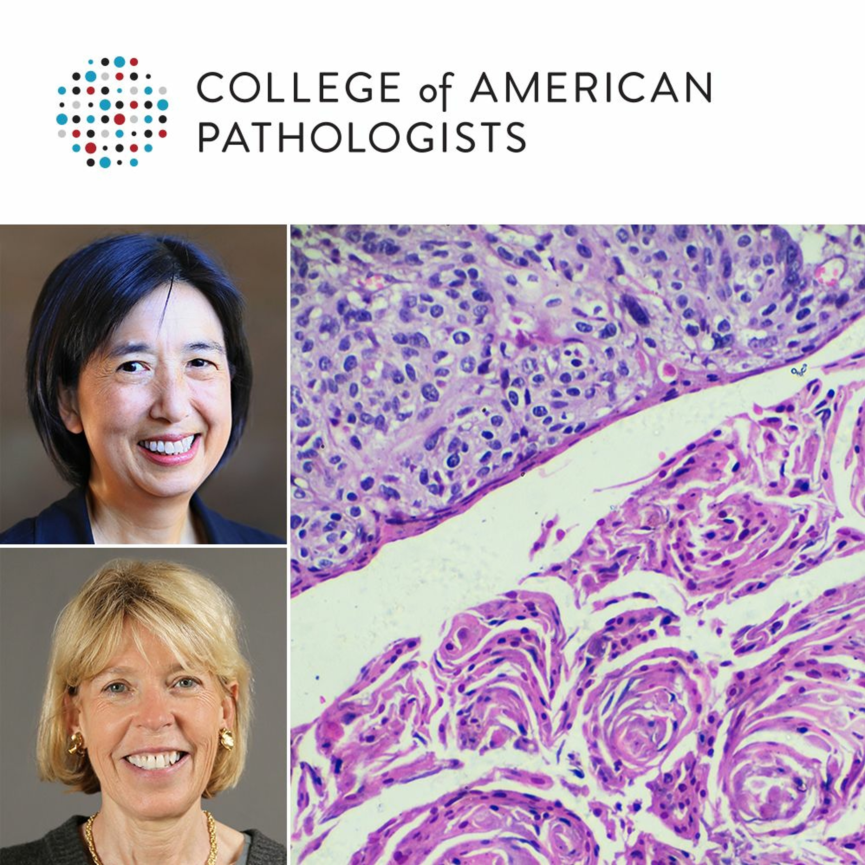 Cervical Adenocarcinoma: Cytology and Histology of Usual Type Adenocarcinomas and Special Variants episode artwork