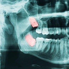Wisdom Tooth