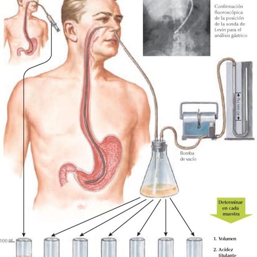 ANÁLISIS GÁSTRICO