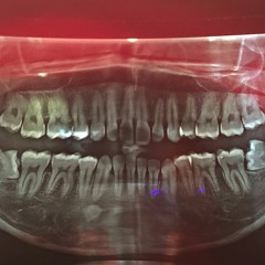 Post-Odontectomy Rumbling