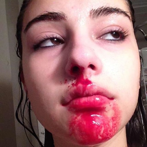 nosebleeds