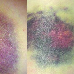 NSTRM011 - excerpt - BRUISING PATTERN / DOSIS LETALIS - SPLIT CS