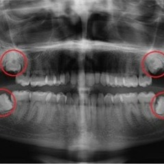 Wisdom Teeth Freestyle