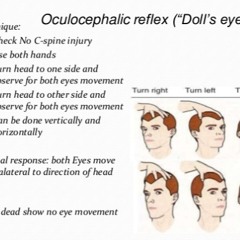 Doll's Eye Reflex