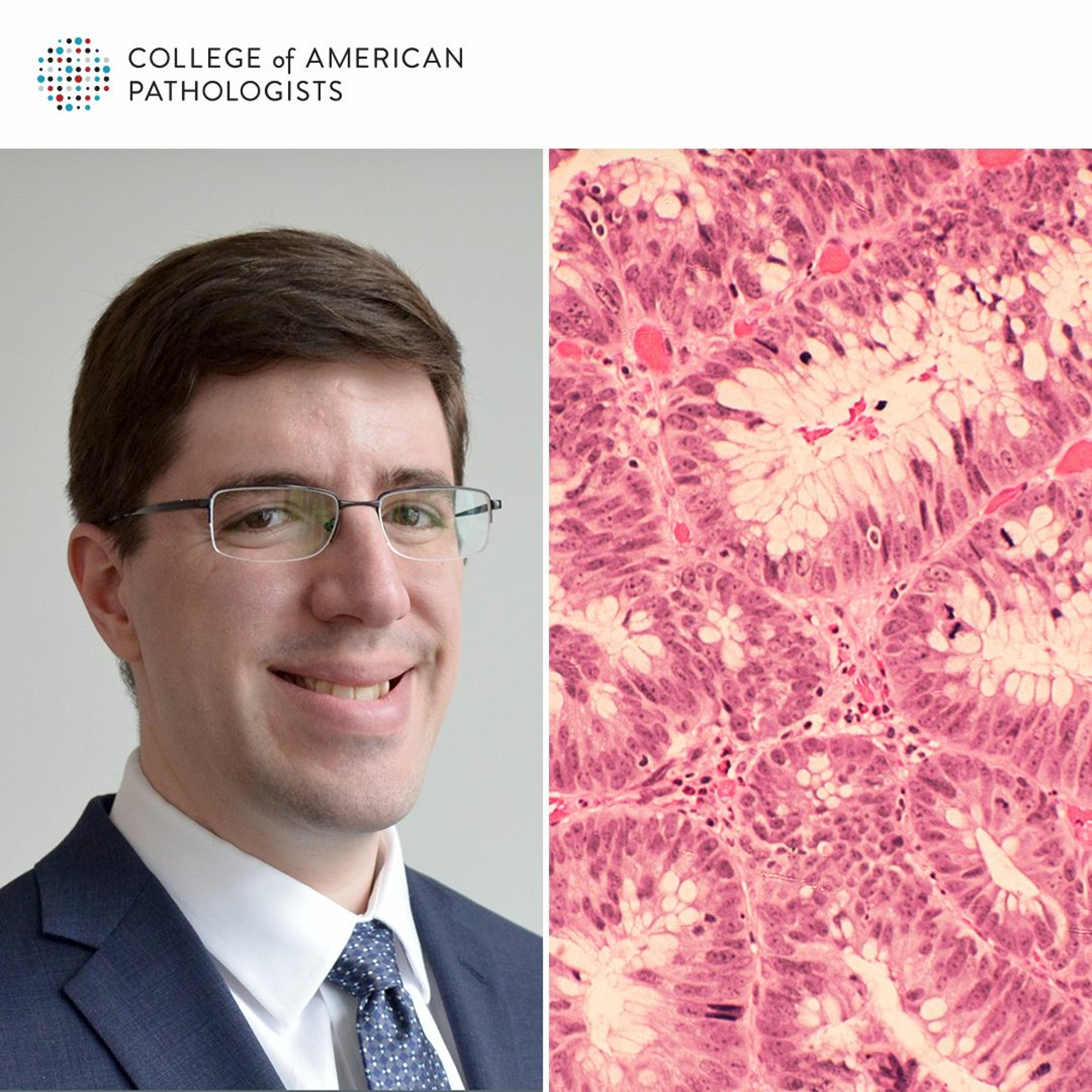 Stains, Deposits, and Buds: Updates on Prognostic Factors in Colorectal Carcinoma episode artwork