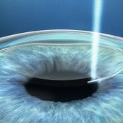 Big News – SMILE Laser Eye Surgery Approved by FDA to Treat Astigmatism
