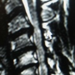 KNECK SURGERY...LCEZ(TOP DOWN)