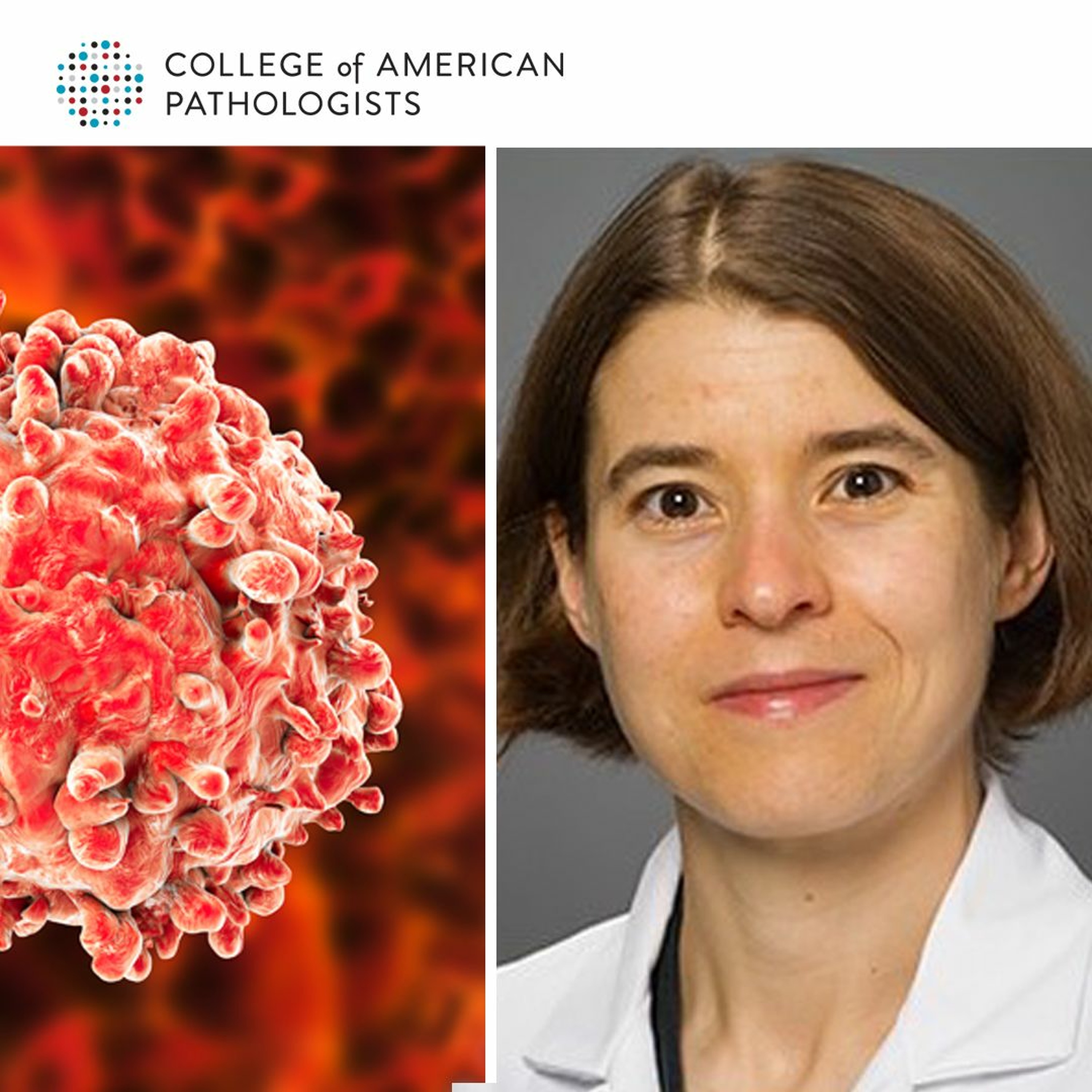 APL with PML-RARA: Pathologists' Crucial Role in this Clinical Emergency episode artwork