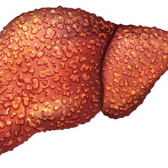 Liver Cirrhosis - Salamat Dok: Liver Fibrosis And Cirrhosis - Dr. Joel Wallach #drjoelwallach