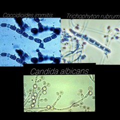 Infecciones producidas por hongos.