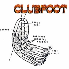Clubfootjam1