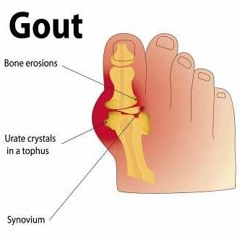 Fuck Gout