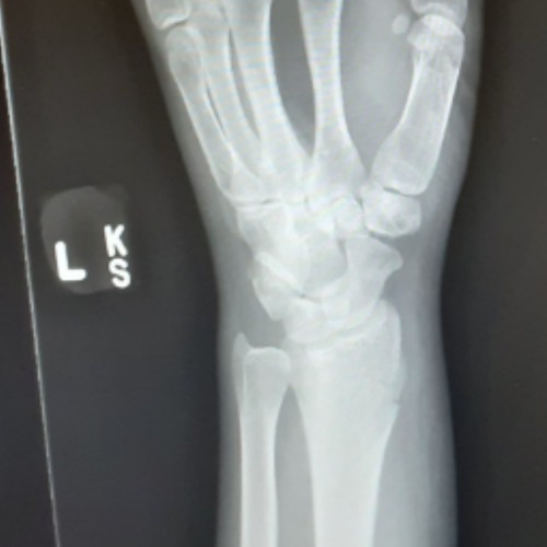 BROKEN WRI$T