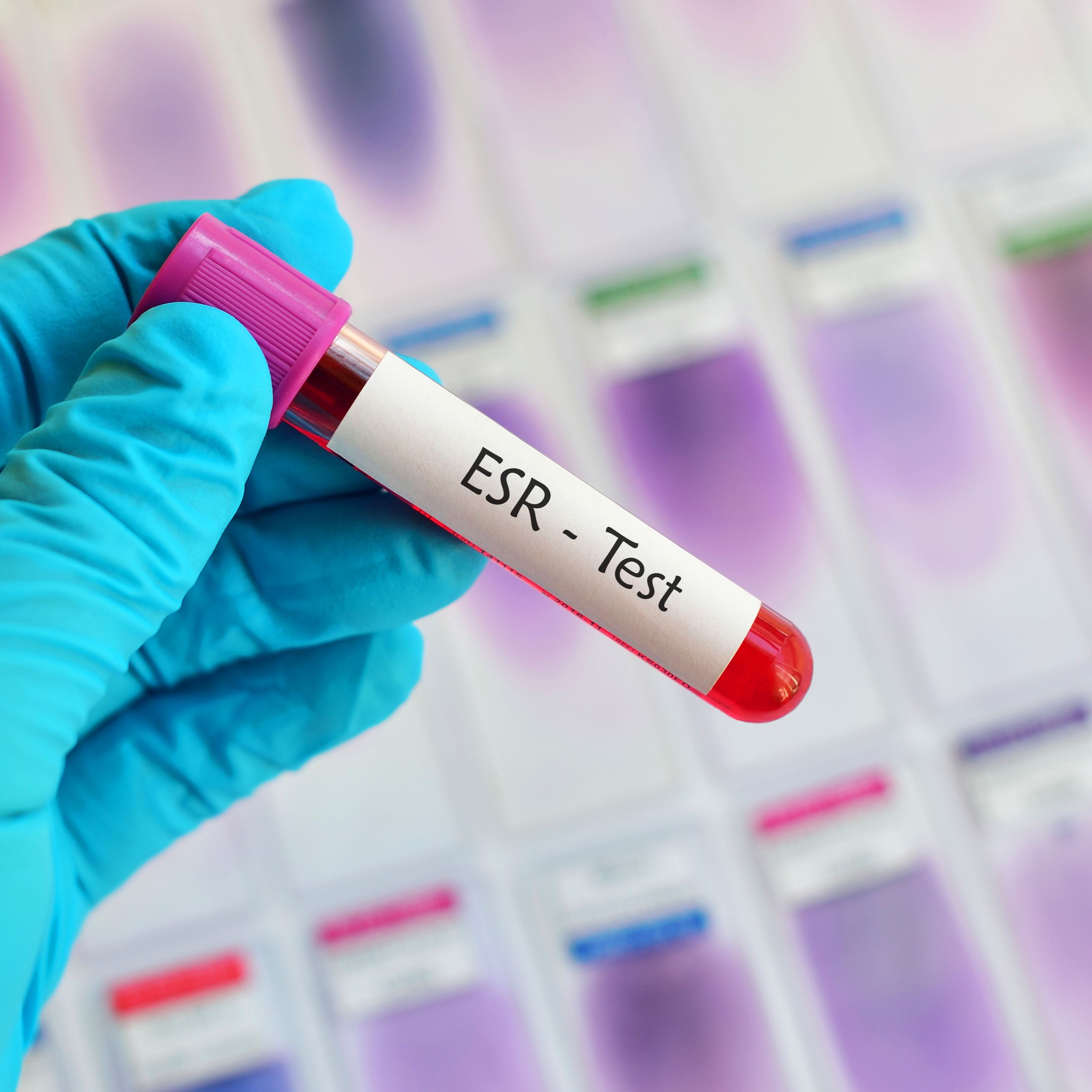 Tips and hacks on the use of ESR and CRP in primary care