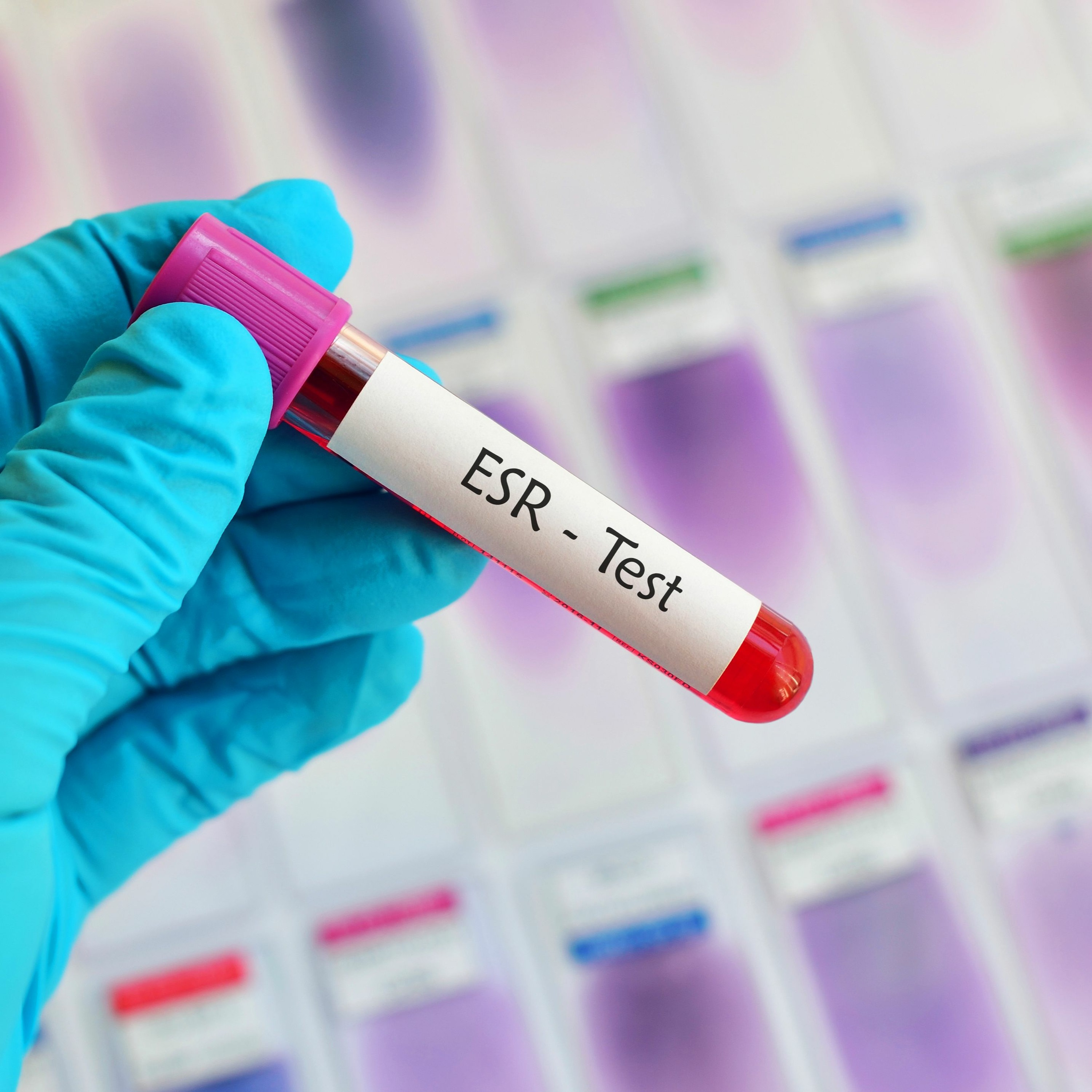 Tips and hacks on the use of ESR and CRP in primary care