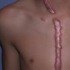 cicatristes