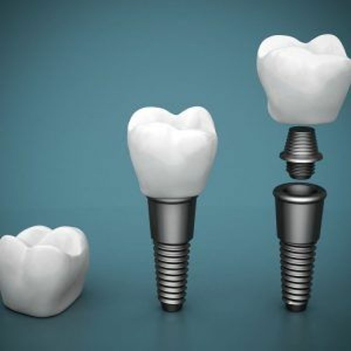 Stream Entenda Como Funciona O Enxerto Ósseo Dentário Para A Instalação De Implantes by Sorriso Stream Entenda Como Funciona O Enxerto Ósseo Dentário Para A Instalação De Implantes by Sorriso