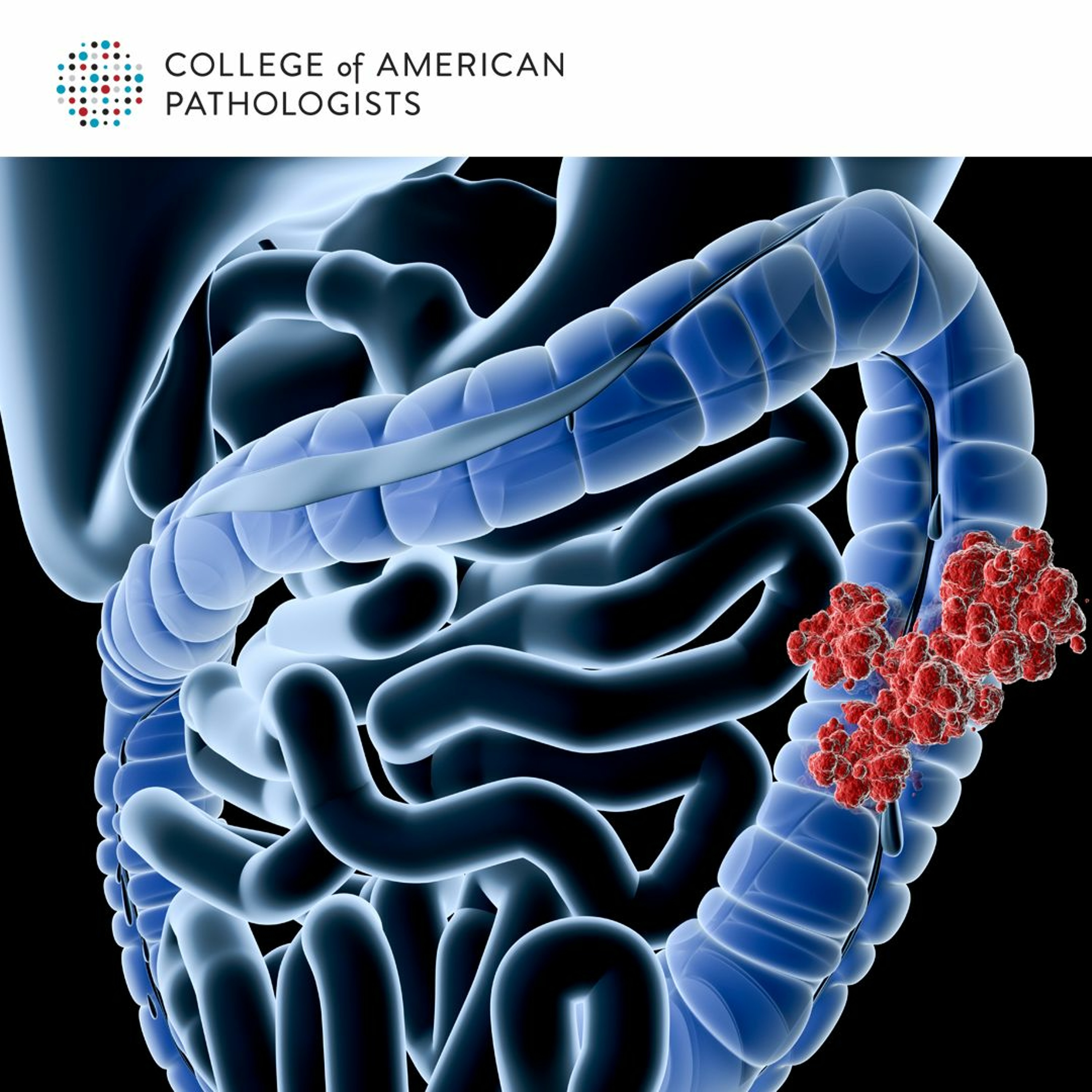 Diagnosing Advanced Colorectal Cancer - What Pathologists Need to Know episode artwork