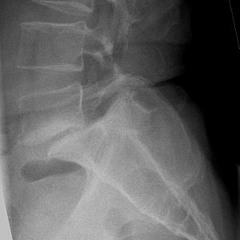 Disc prolapse, spondylolisthesis, & Degenerative spine
