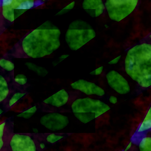 Hyperreflective Crystal Formation