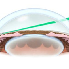 Best Slt Eye Laser Treatment Reviews