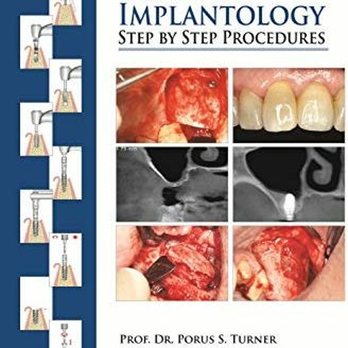 Access KINDLE PDF EBOOK EPUB Clinical Guide to Oral Implantology: Step by Step Proced