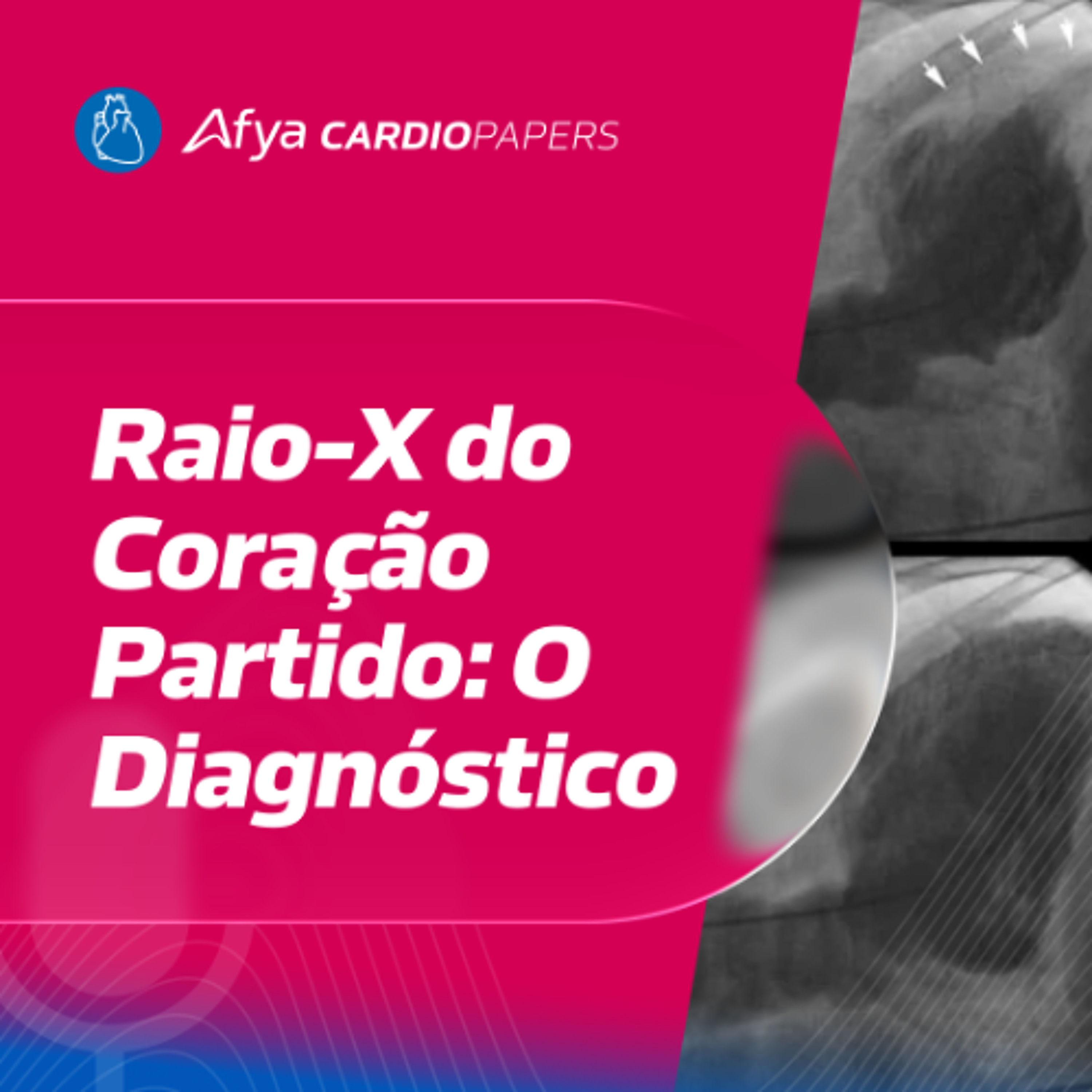 Como confirmar o diagnóstico de Síndrome de Takotsubo?