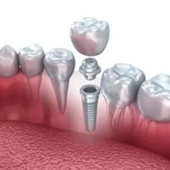 Why Choose Dental Implants for a Lasting Smile?