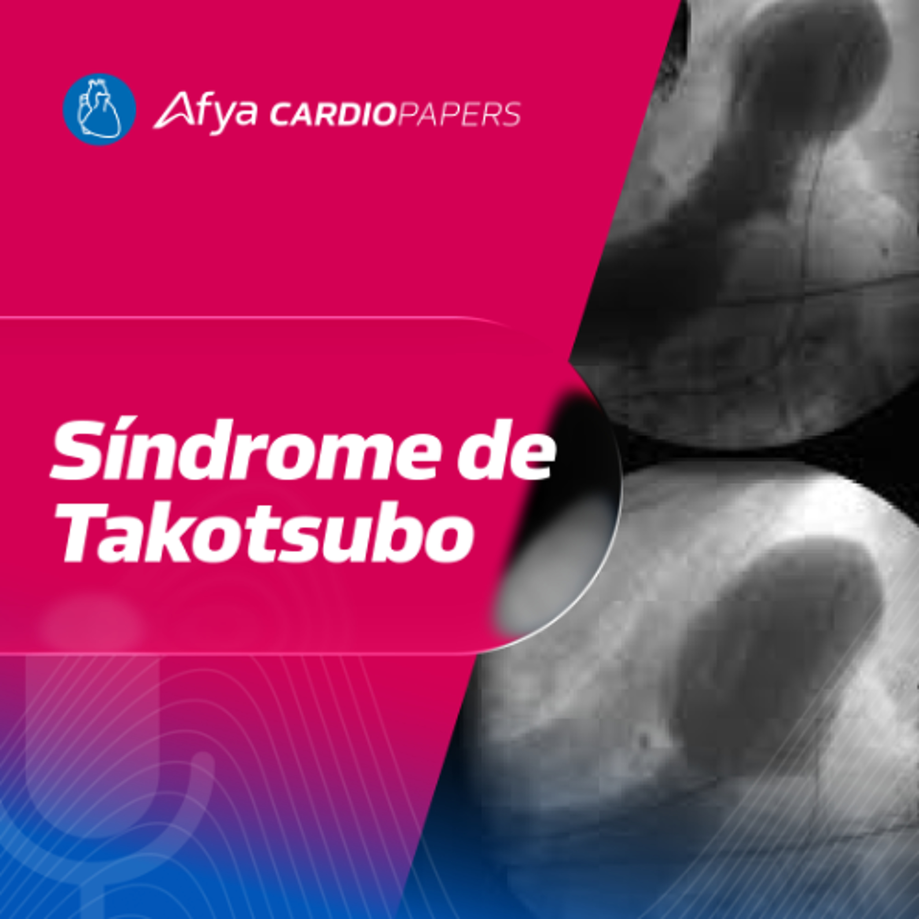 Síndrome de Takotsubo