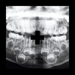 Milk Teeth